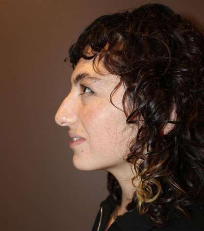 Rhinoplasty Patient Results: before