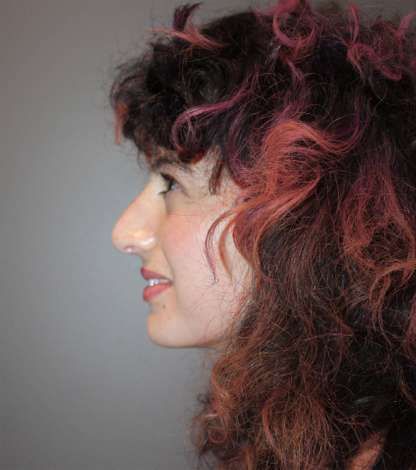 Rhinoplasty Patient Results: after