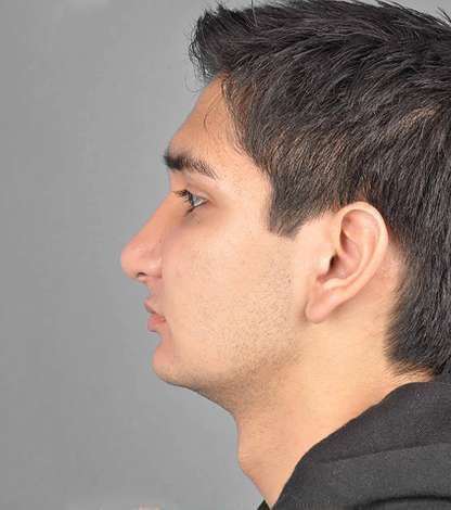 Rhinoplasty Patient Results: after