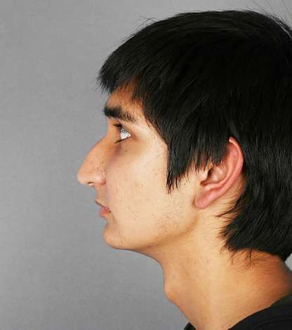 Rhinoplasty Patient Results: before